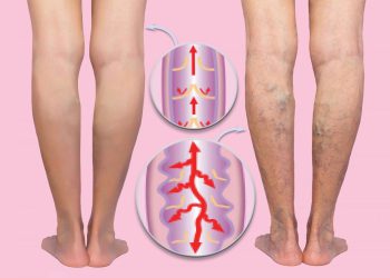 Θρόμβωση: 40% των Ασθενών με Κιρσούς καταλήγουν με Θρόμβωση στο Πόδι