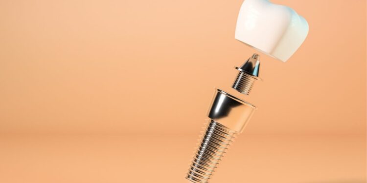 Εμφυτεύματα Δοντιών και Laser: Μία Υπερσύγχρονη Μέθοδος
